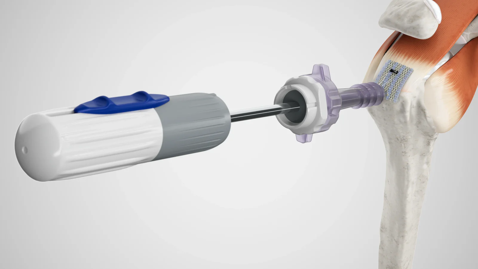 3D render of Anika’s Integrity implant system being applied to a shoulder joint